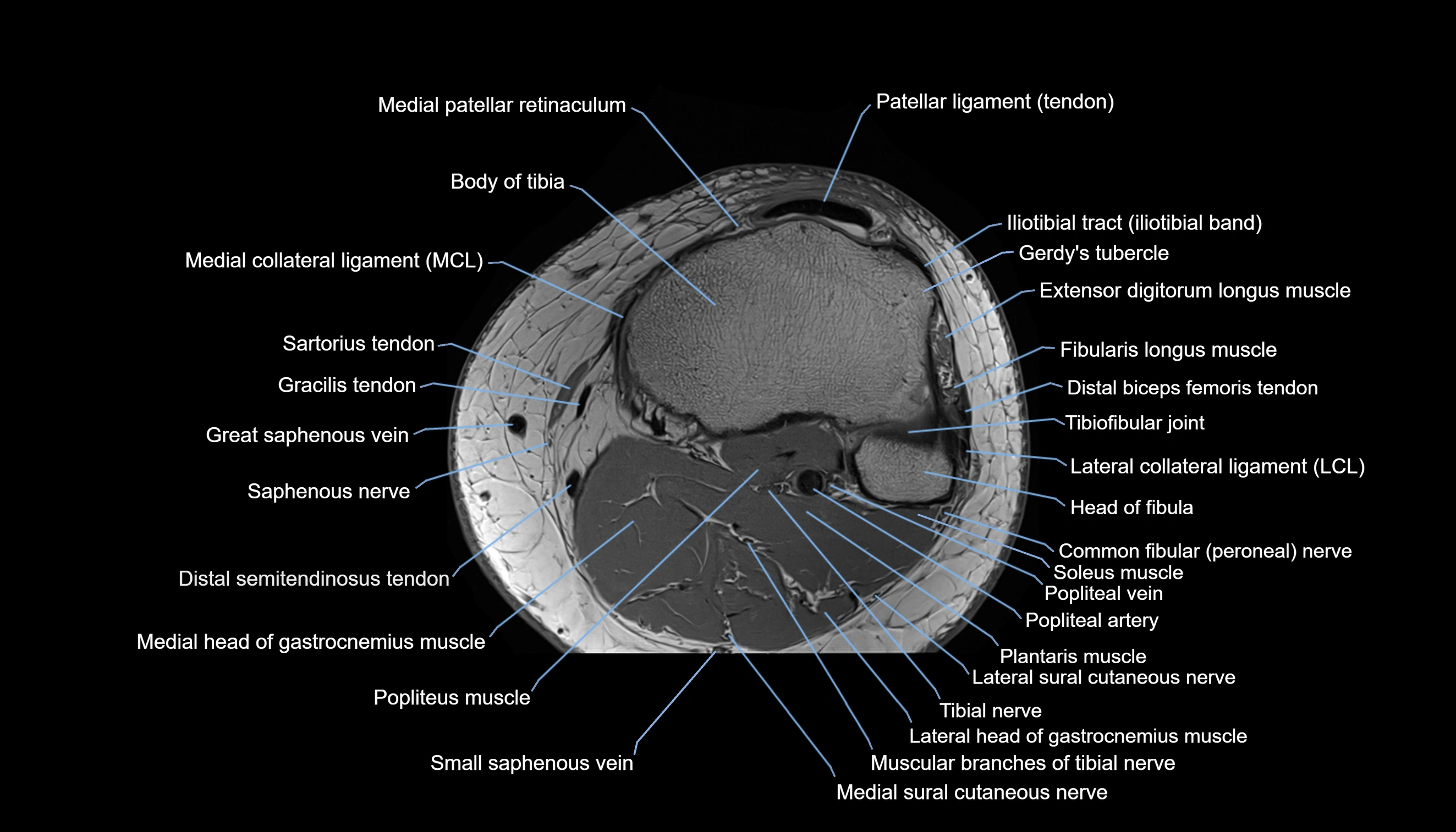 MRI knee  axial cross sectional anatomy 3T radiology  image-img-00001-00040.webp